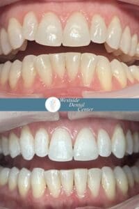 Invisalign Case Catherine