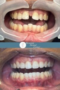 Invisalign Case Latosha