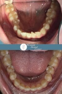 Invisalign Case Lucia