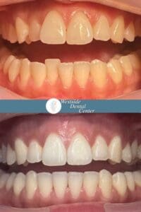 Invisalign Case Mar