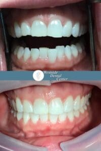 Invisalign Case No consent 1