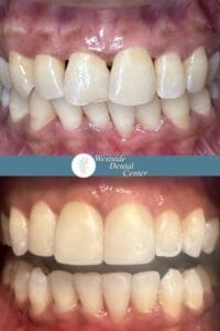 Invisalign Case No consent 2